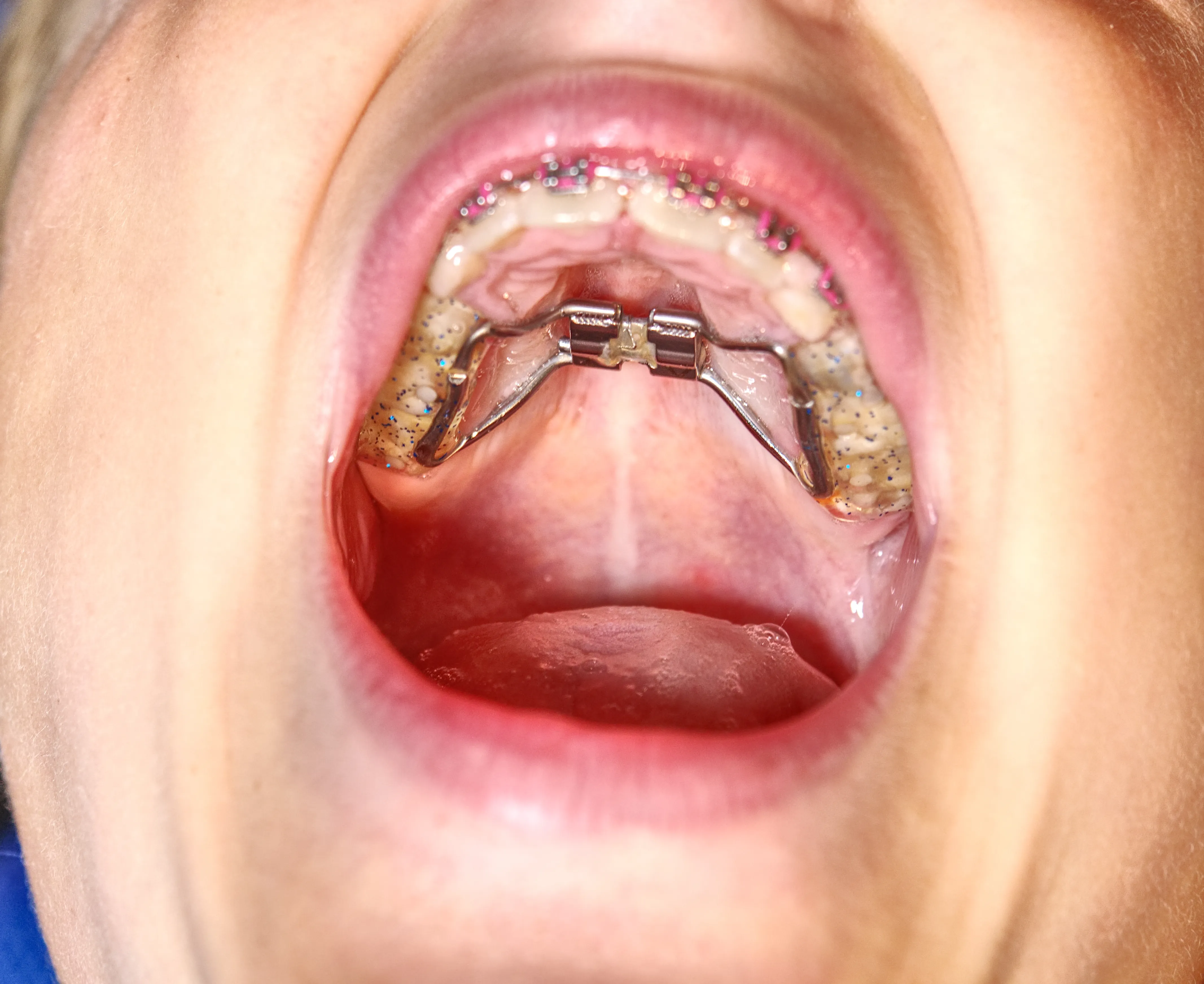 What Are Palate Expanders?