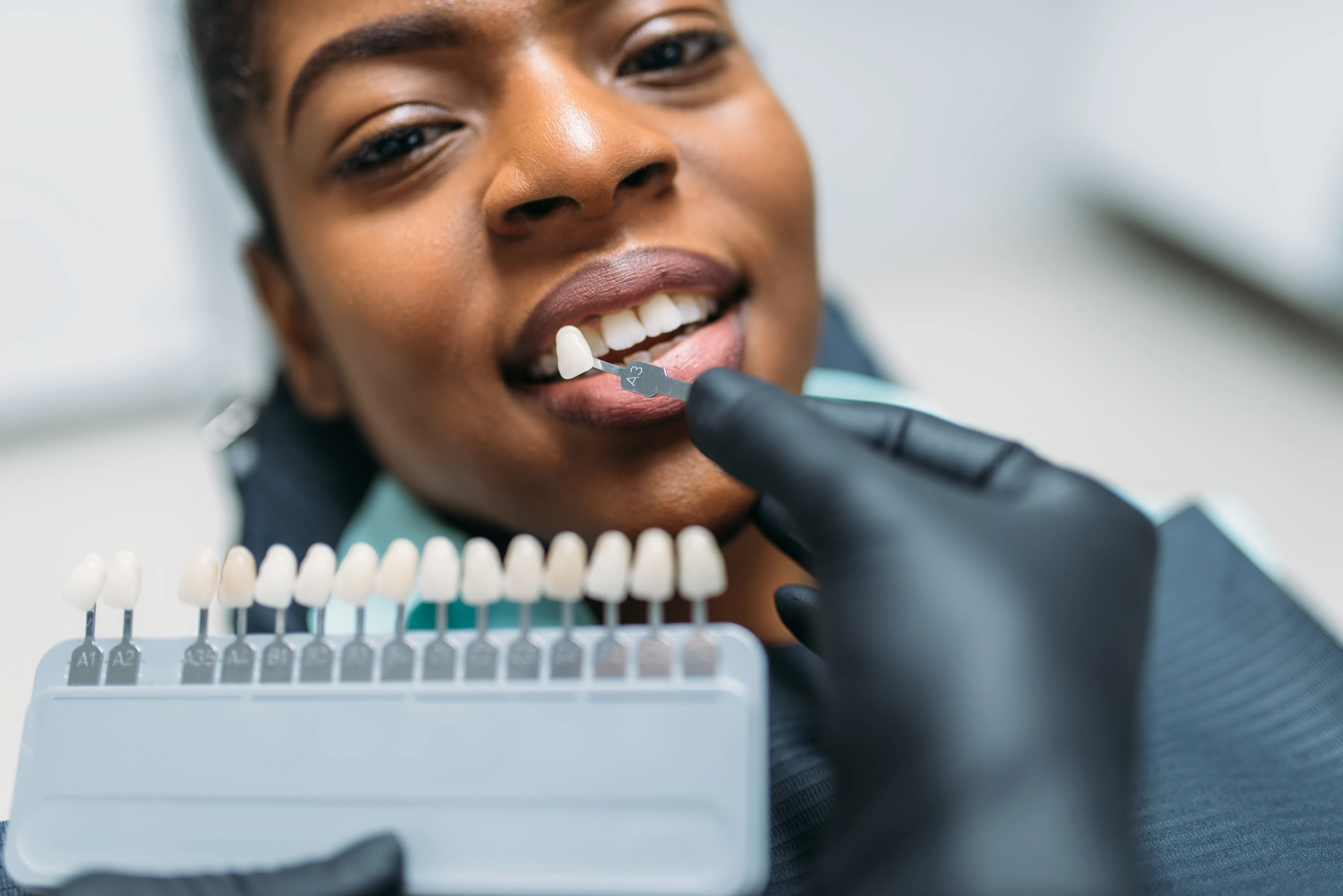 What Are Veneers?