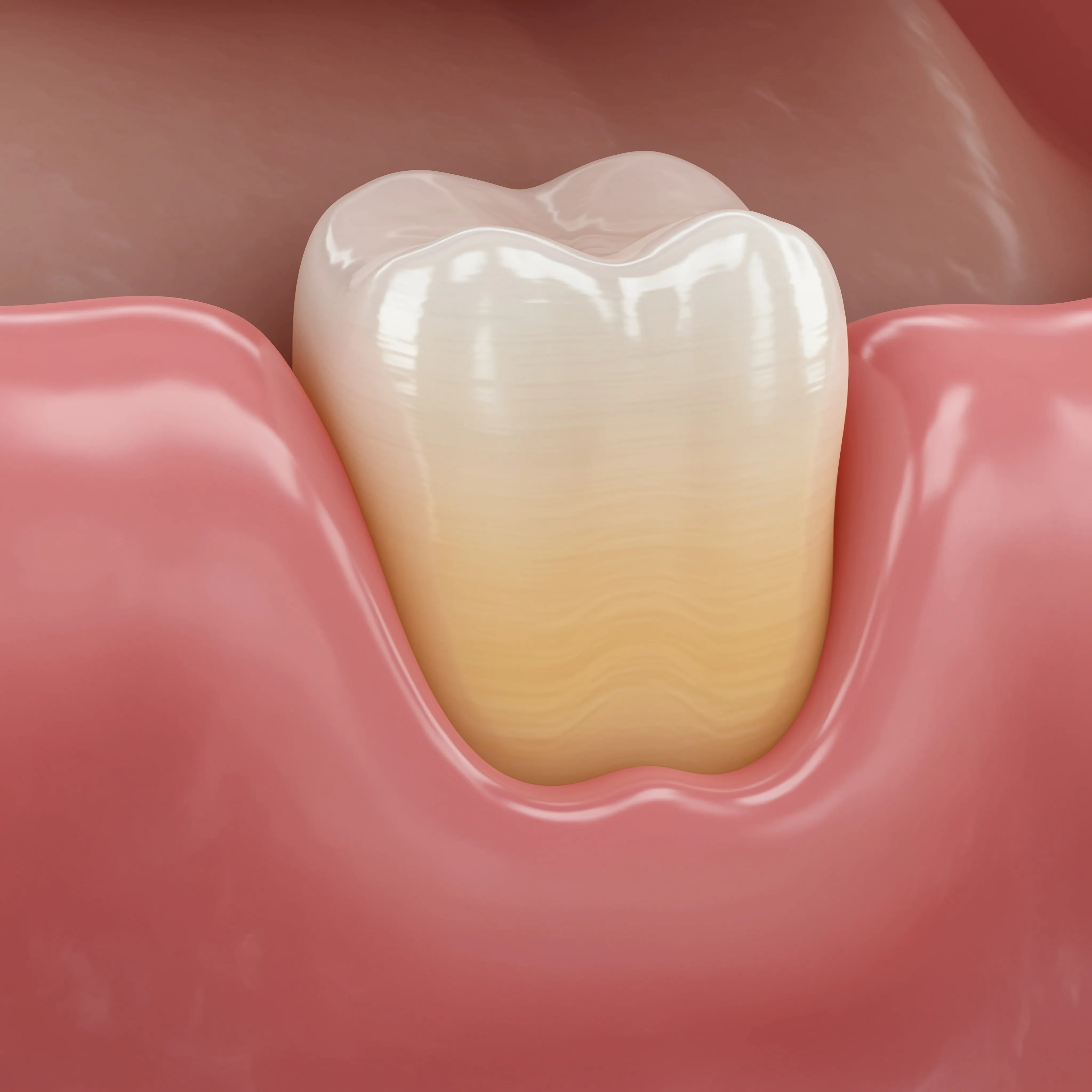 What Is an Operculectomy?